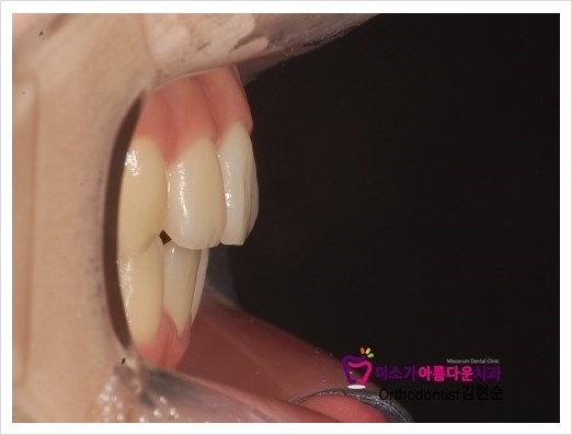 세라믹치과 돌출입교정치과 관련 이미지 4