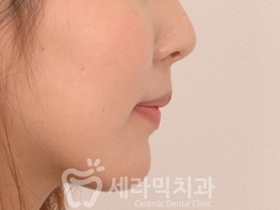 덧니와 돌출입을 한번에! 치아교정 전후사진 관련 이미지 20
