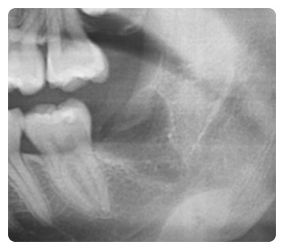 학동역 사랑니발치 관련 이미지 5