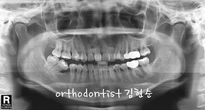 강남 덧니, 돌출 관련 이미지 12