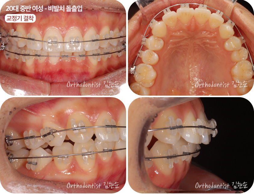 돌출입 비발치 치아교정 관련 이미지 6