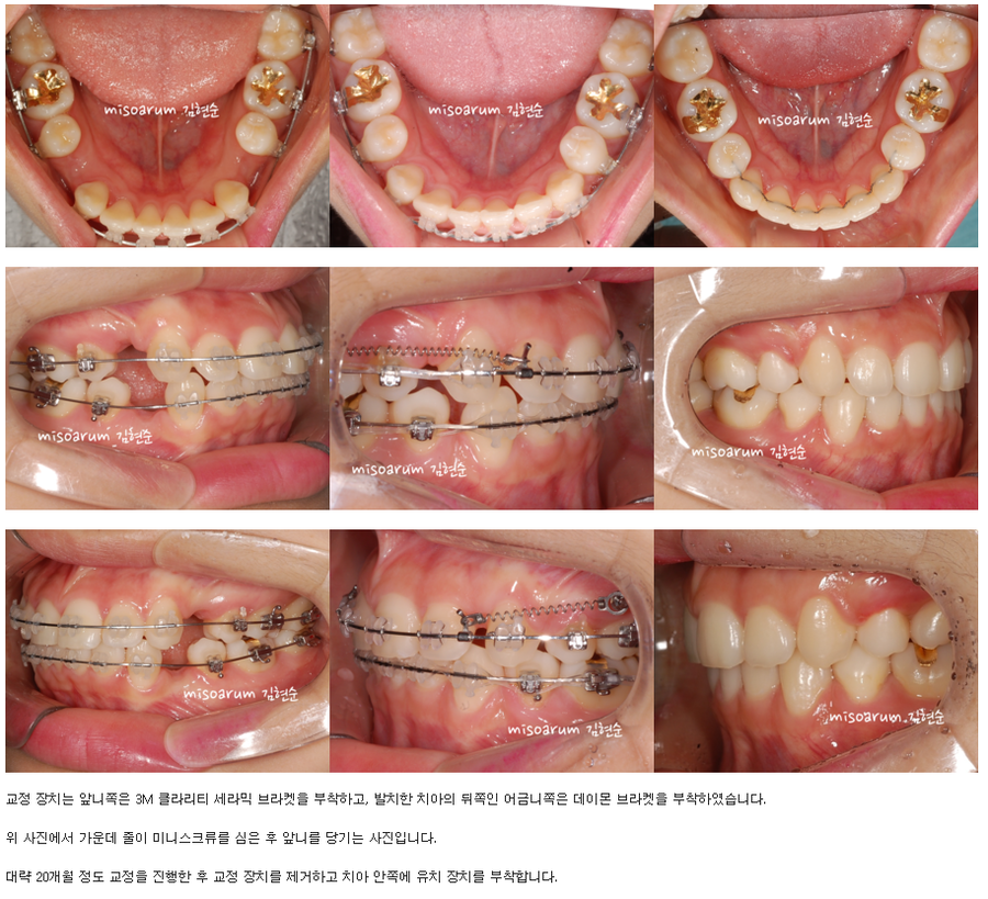 세라믹교정 세라믹치과-돌출입발치교정 9 관련 이미지 4