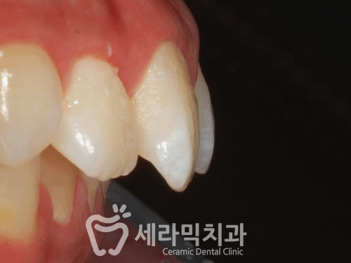 청소년교정 10대교정 딥바이트 과개교합 치아교정전후 관련 이미지 10