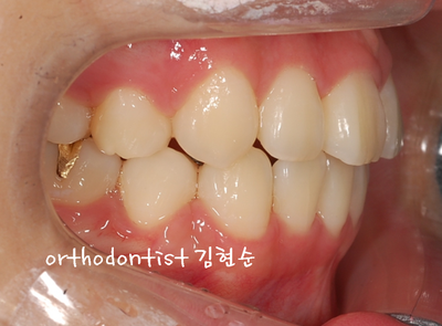 강남 덧니 관련 이미지 27