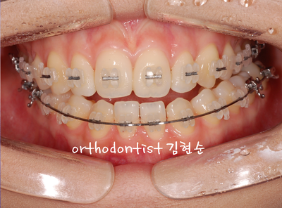 개방 교합 관련 이미지 21