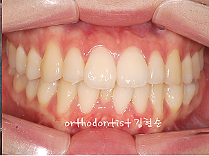 강남 돌출입 교정 관련 이미지 6