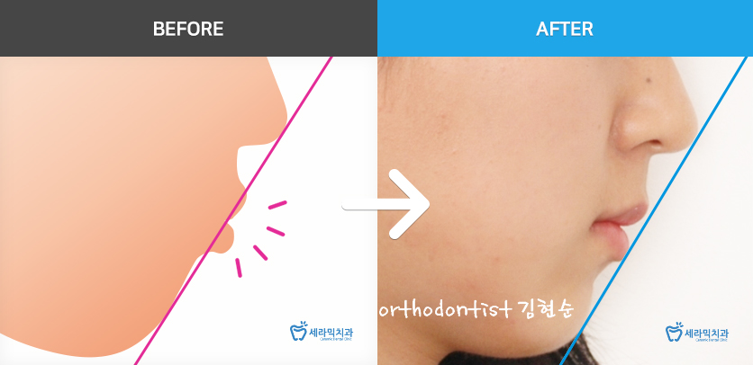 학동역치과 미국3M교정 추천 ~~ 관련 이미지 10