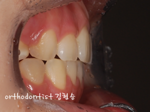 강남 돌출입 교정 관련 이미지 17