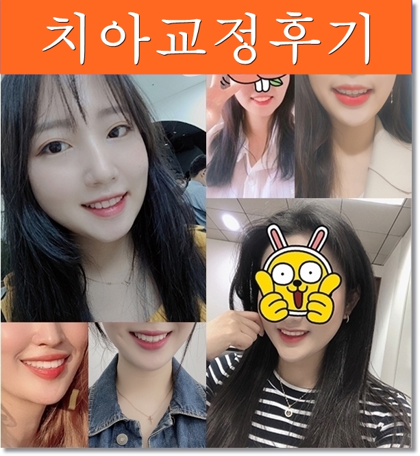 돌출입 치아교정전후, 갸름하고 부드러운 옆라인 완성! 관련 이미지 9