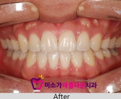 세라믹치과 돌출입교정 관련 이미지 5