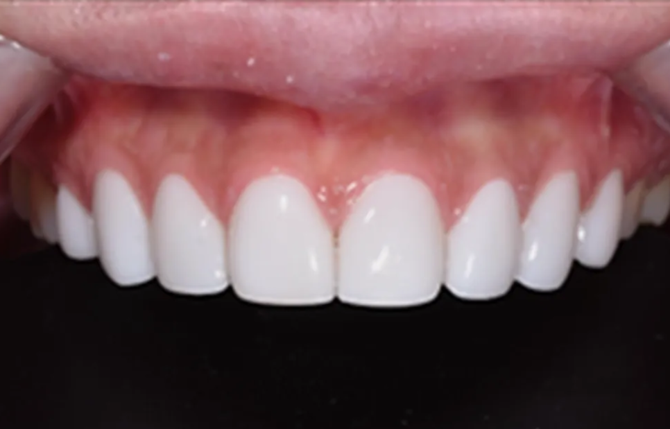 학동역 라미네이트 전후, 치아 모양과 색상 개선 사례 관련 이미지 10