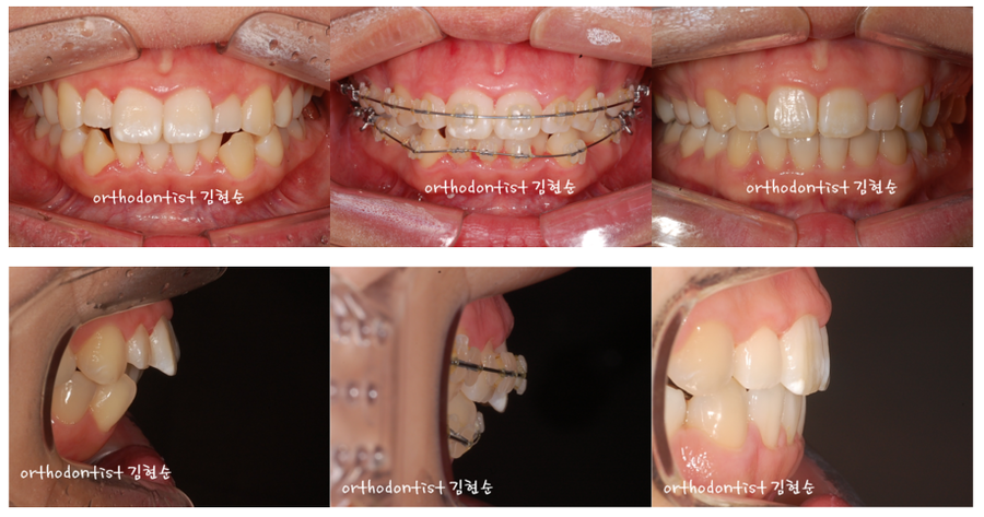 미니스크류, 돌출입 발치 교정 잇몸노출 개선 관련 이미지 7