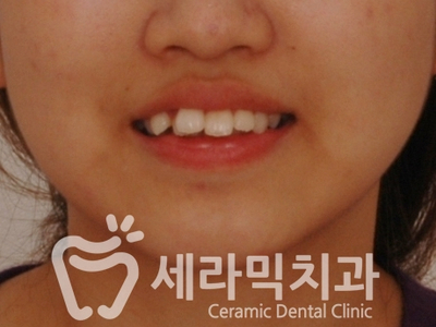 치아교정 전후 스마일라인 변화!(돌출입,토끼앞니, 중심선 비대칭 동시 교정) 관련 이미지 4