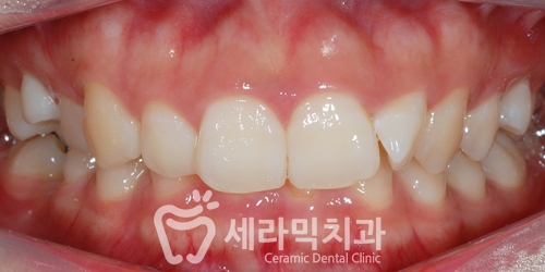 딥바이트(과개교합) 때문에 감추고 싶던 치아, 치아교정전후 달라진 미소 관련 이미지 3