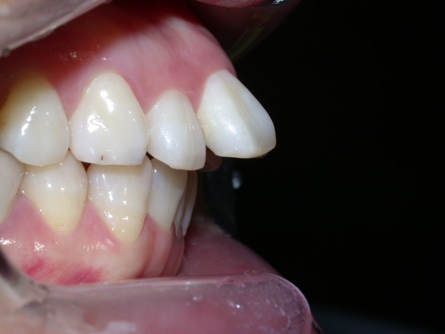 [강남치아교정] 치아교정기간 줄이는 방법 관련 이미지 6