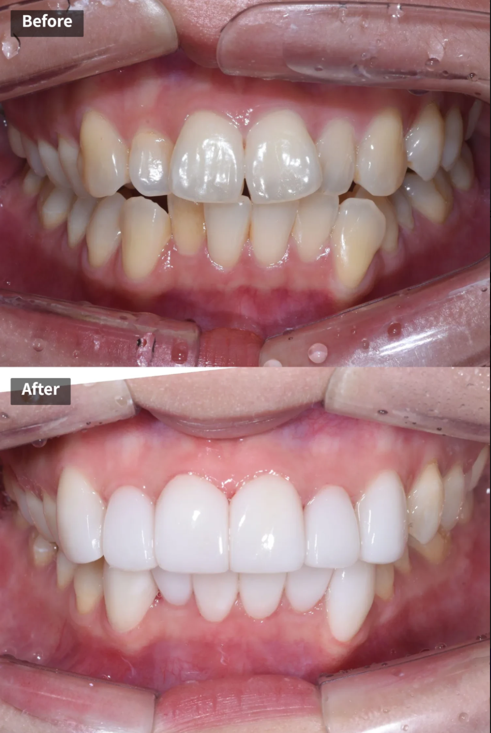 세라믹 치과, 삐뚤빼뚤한 치아를 교정 없이 라미네이트로 치료한 사례 관련 이미지 1