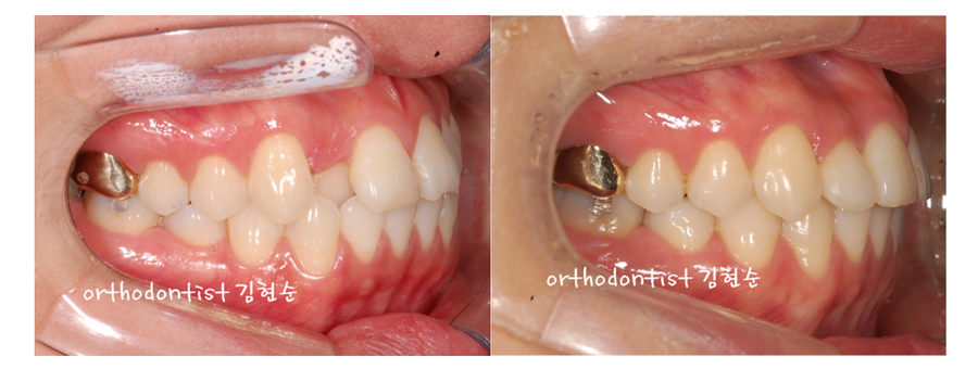 안면비대칭 교정, 치아교정만으로 간단히 해결하기 관련 이미지 16