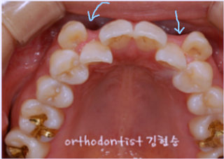강남 덧니 관련 이미지 3