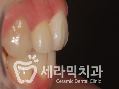 치아교정 전후 스마일라인 변화!(돌출입,토끼앞니, 중심선 비대칭 동시 교정) 관련 이미지 16