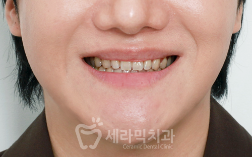 강남라미네이트치과 세라네이트 전후 사례 - 달라진 스마일라인 관련 이미지 2