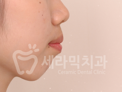 돌출입 치아교정 사례(학동역 치아교정 세라믹치과) 관련 이미지 4