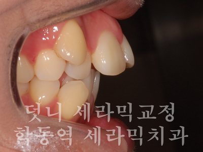 덧니교정 잘하는 학동역 교정치과, 세라믹치과 관련 이미지 4