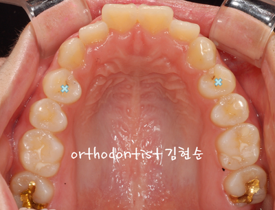 강남 돌출 관련 이미지 14