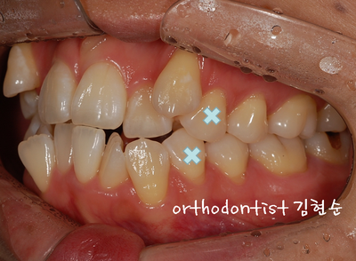 강남 덧니 관련 이미지 14