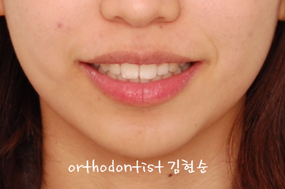 강남 돌출 관련 이미지 32