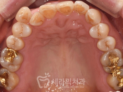 40대에 이어 50대 치아교정 전후사례 증가 추세 관련 이미지 12