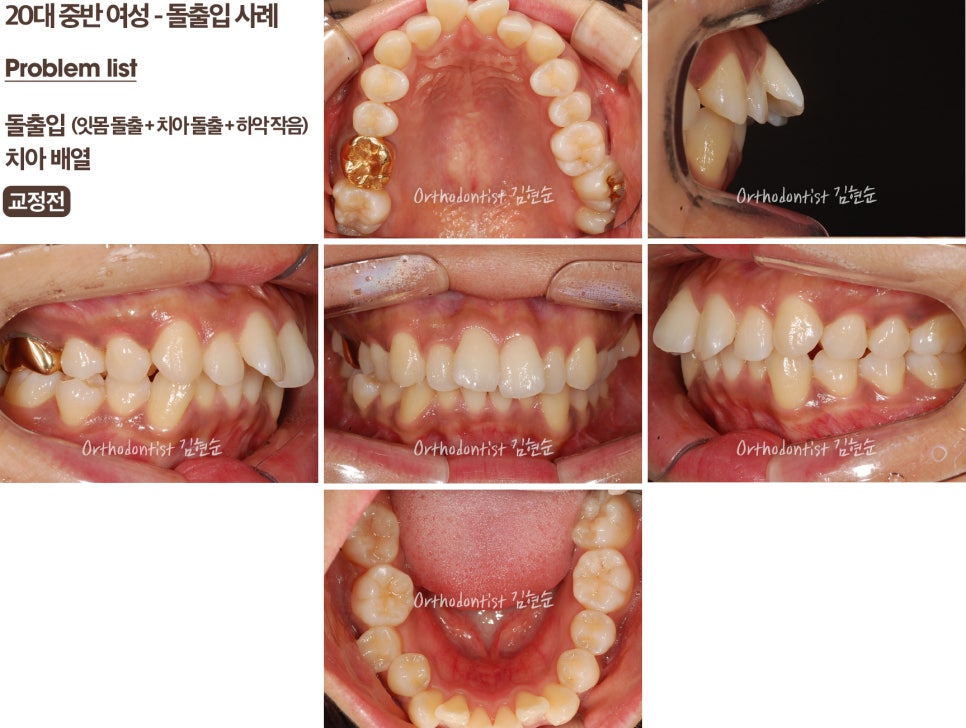 학동역치과 치아교정은 여기서 !! 관련 이미지 11