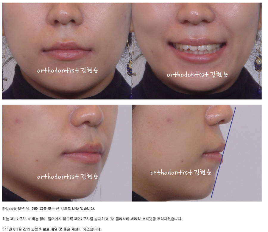 돌출입발치 교정증례 관련 이미지 3