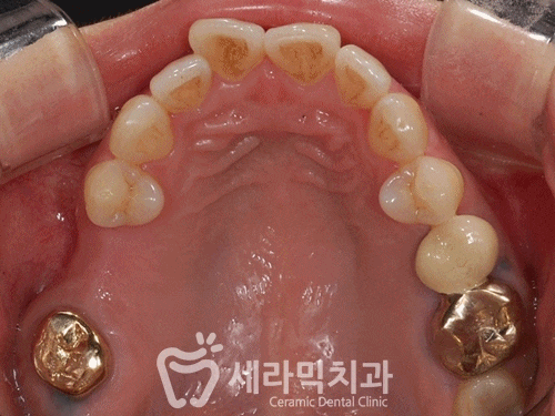 상실된 치아가 있어도, 금니가 있어도 치아교정전후는 계속된다! 관련 이미지 8