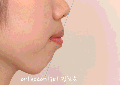 강남 돌출 관련 이미지 6