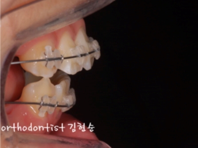강남치아교정추천 관련 이미지 17