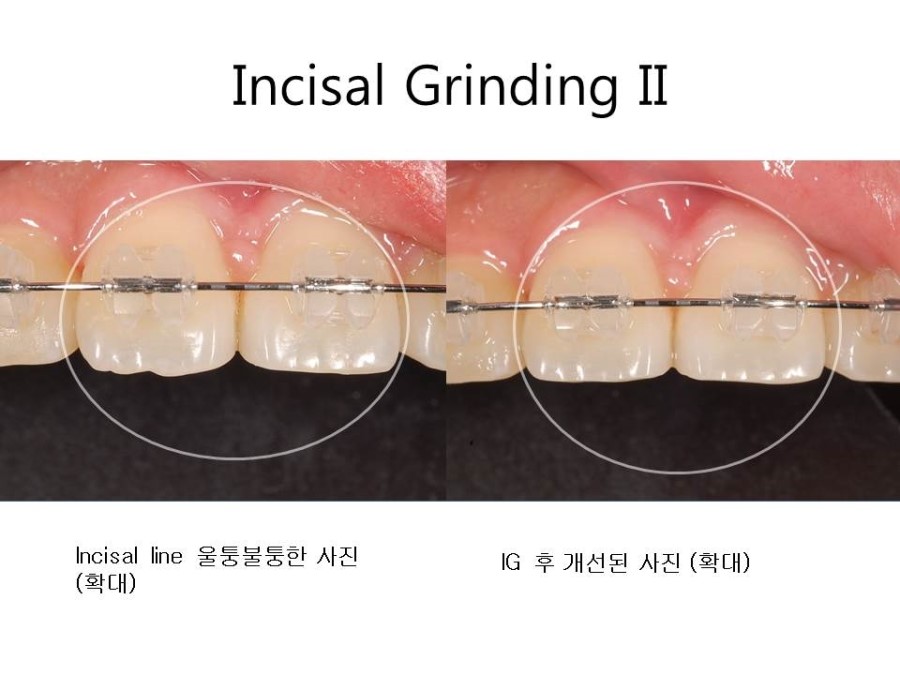 학동역치과 치아교정 잘하는 곳 ! 관련 이미지 30