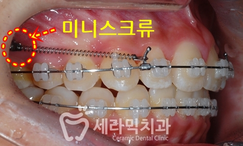 청소년교정 10대교정 딥바이트 과개교합 치아교정전후 관련 이미지 8