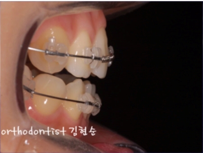 강남교정치과 관련 이미지 15