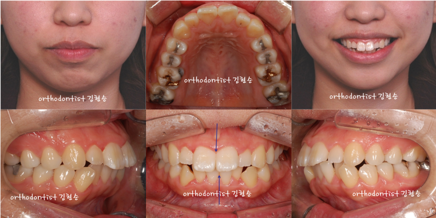 미니스크류, 돌출입 발치 교정 잇몸노출 개선 관련 이미지 5
