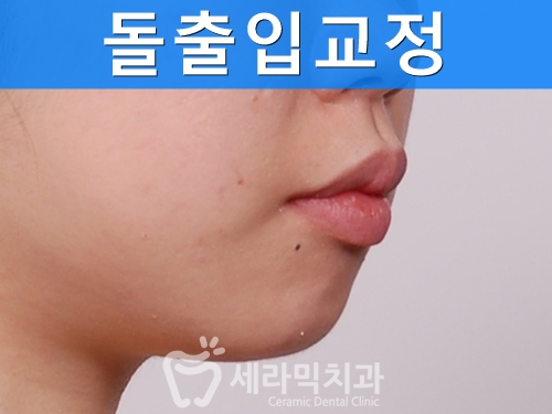 깨진 후에 후회하는 돌출입, 치아교정으로 건강하고 가지런한 치아만들기 관련 이미지 1