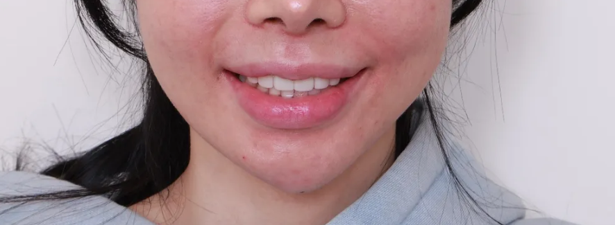 A Case of Improving the Smile Line Along with Replacing a Front Tooth Crown image 8
