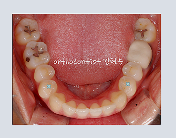 강남교정치과 관련 이미지 16