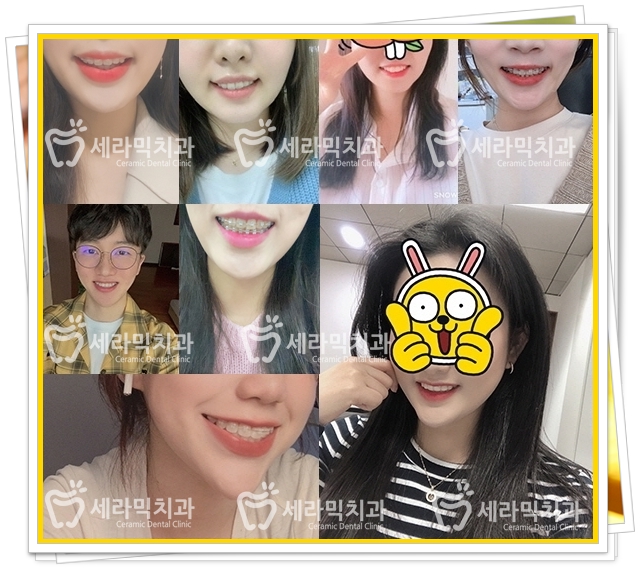 세라믹치과 치아교정전후 : 앞니반대교합+치열불규칙 관련 이미지 10