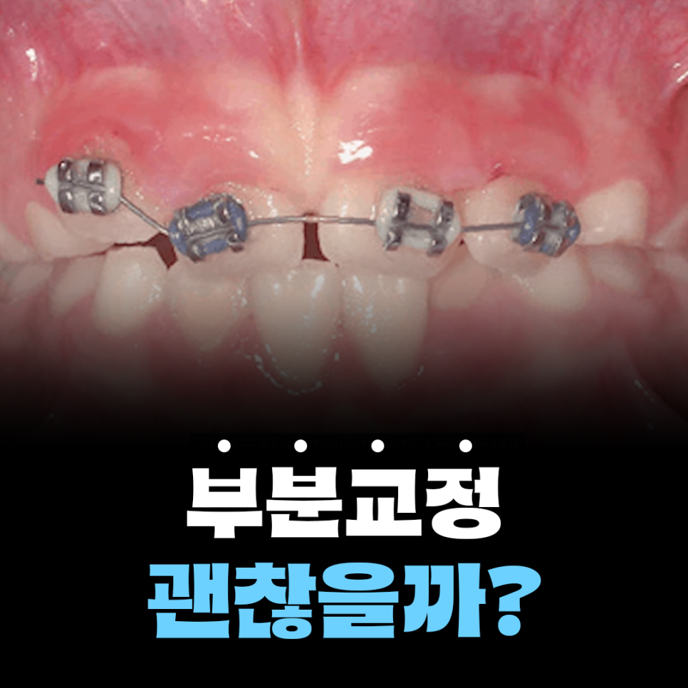 토끼이빨 앞니 부분교정, 실패하지 않는 방법은 관련 이미지 1