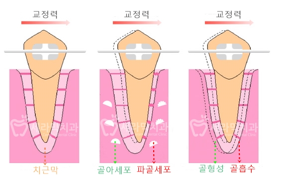 성인교정, 40대 50대 치아교정 잘하는 세라믹치과 치아교정전후 관련 이미지 2