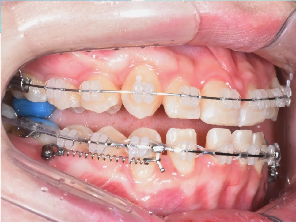언주역 치과, 주걱턱 + 과개교합을 비수술로 치료한 사례 관련 이미지 8