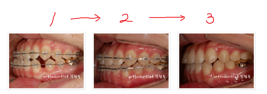 주걱턱수술 안하고 양악수술 안하고 관련 이미지 12