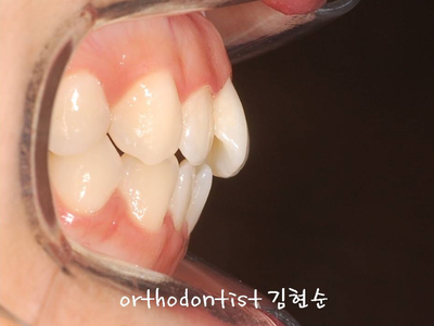 강남 돌출입 교정 관련 이미지 11