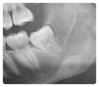 학동역 사랑니발치 관련 이미지 4