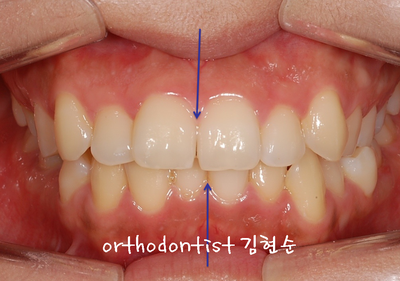 강남 돌출 관련 이미지 11